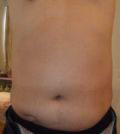 Lipox痩身システム 写真2